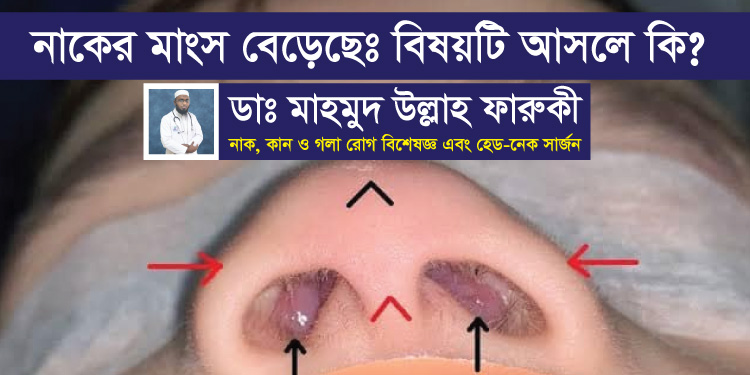 নাকের মাংস বেড়েছেঃ আসলে বিষয়টা কি?