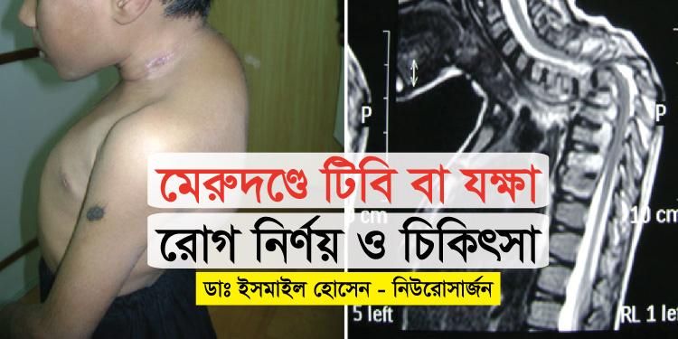 মেরুদণ্ডে টিবি বা যক্ষা নির্ণয় ও চিকিৎসা