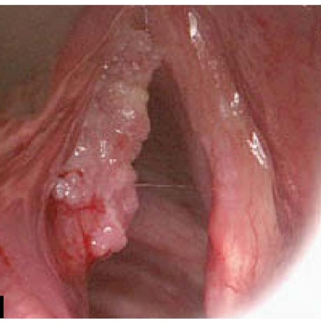 স্বরযন্ত্রের ক্যান্সার