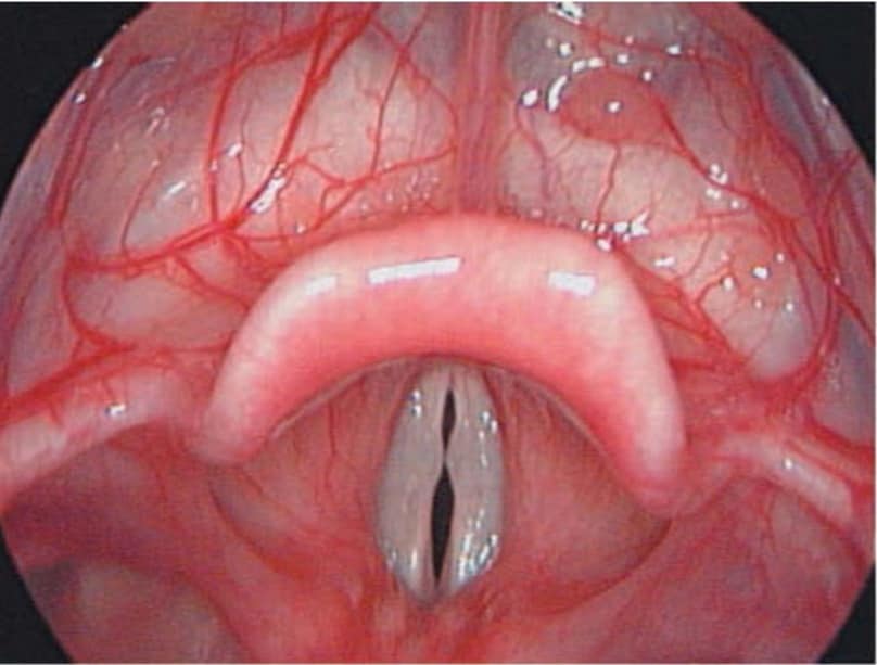 স্বর যত্রের পলিপ