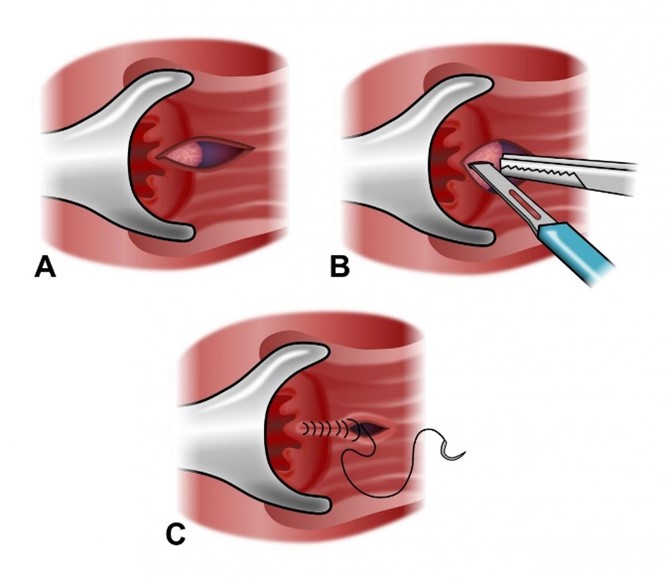 Lateral internal sphincterotomy