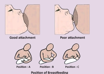 breast position