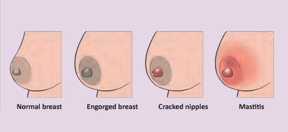 common mother breast problem